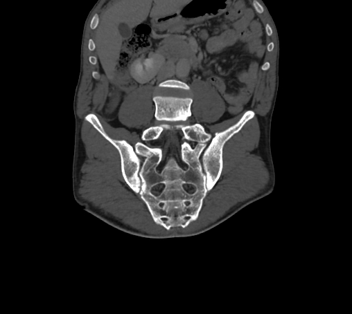 Bronchiectasis in Crohn disease (Radiopaedia 60311-67977 Coronal bone window 38).jpg