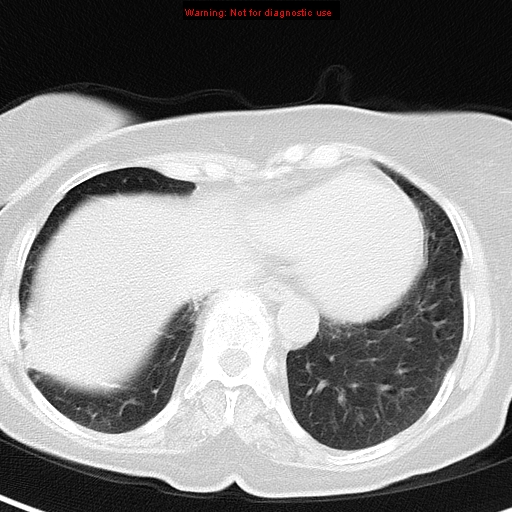 File:Bronchoalveolar carcinoma (BAC) (Radiopaedia 13436-13392 Axial lung window 39).jpg