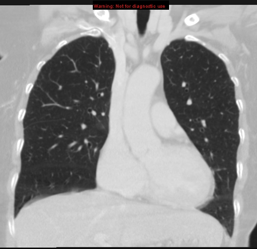 Bronchoalveolar carcinoma (BAC) (Radiopaedia 13436-13392 Coronal lung window 22).jpg