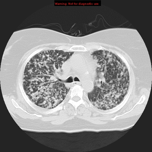 Bronchoalveolar carcinoma (Radiopaedia 13224-13233 Axial lung window 17).jpg