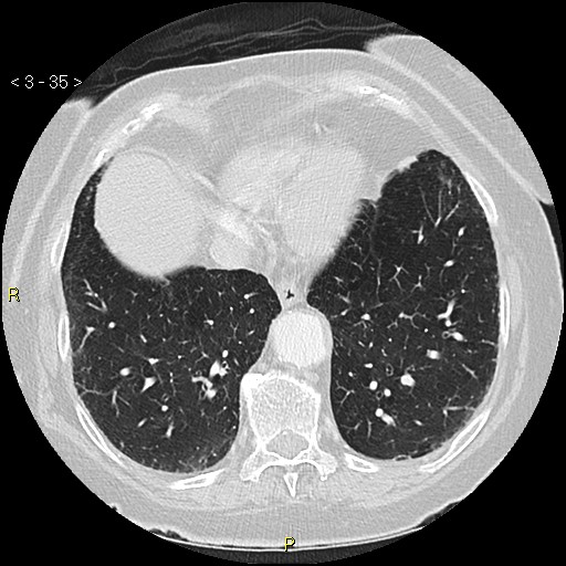 Bronchogenic carcinoma as an incidental finding (Radiopaedia 16453-16130 Axial lung window 35).jpg