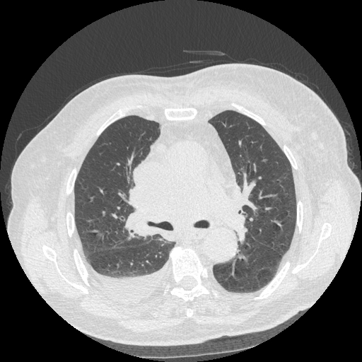 Bronchogenic carcinoma with metastatic lymphadenopathy (Radiopaedia 37671-39569 Axial lung window 24).jpg