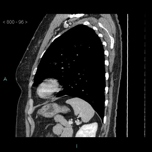 Bronchogenic cyst - posterior mediastinal (Radiopaedia 43885-47364 B 63).jpg