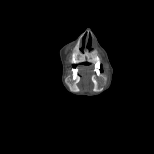 File:Brown tumor with secondary hyperparathyroidism (Radiopaedia 23591-23705 bone window 7).jpg