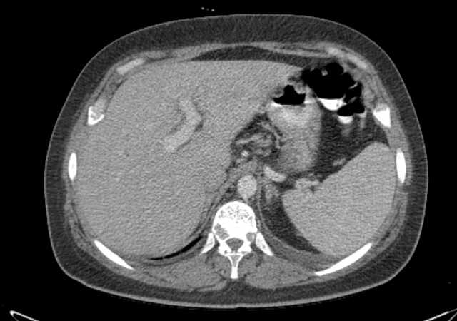 File:Brown tumors compressing the spinal cord (Radiopaedia 68442-77988 E 27).jpg