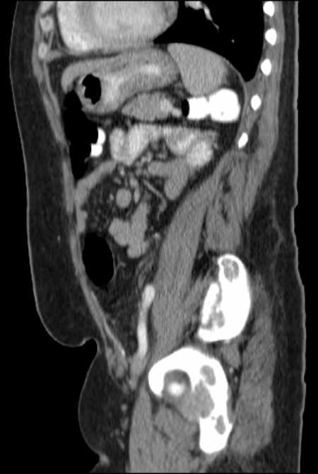 Brown tumors compressing the spinal cord (Radiopaedia 68442-77988 F 38).jpg