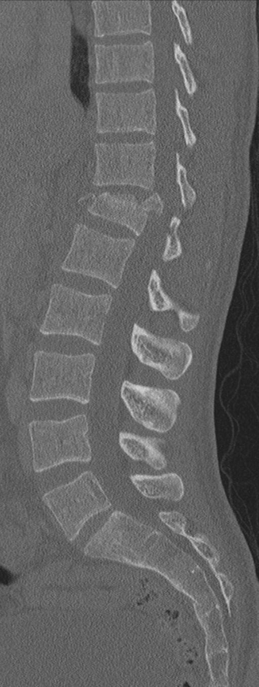 Burst fracture - T12 with conus compression (Radiopaedia 56825-63647 Sagittal bone window 44).png