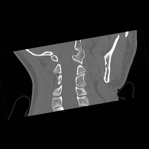 File:C1-C2 "subluxation" - normal cervical anatomy at maximum head rotation (Radiopaedia 42483-45607 Coronal non-contrast 35).jpg