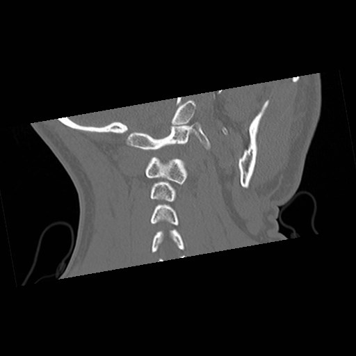 C1-C2 "subluxation" - normal cervical anatomy at maximum head rotation (Radiopaedia 42483-45607 Coronal non-contrast 43).jpg