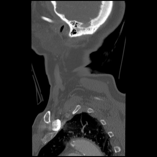 File:C1 anterior arch (plough) fracture - type 1 (Radiopaedia 76181-87720 Sagittal bone window 13).jpg