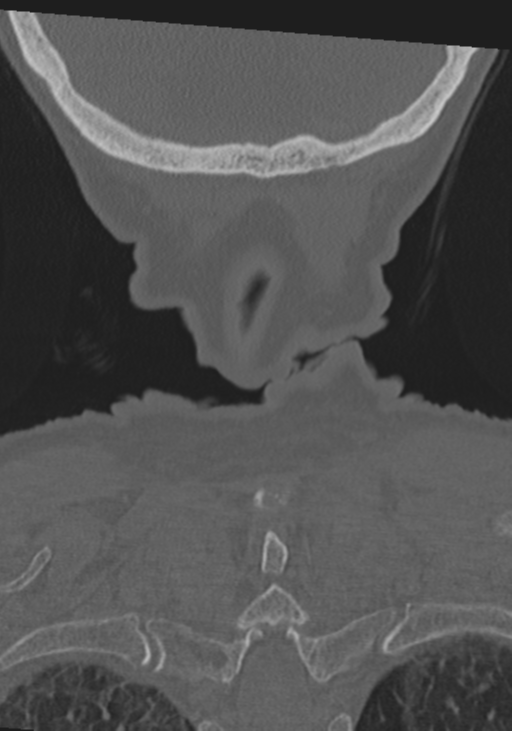 C2 fracture with vertebral artery dissection (Radiopaedia 37378-39199 Coronal bone window 56).png