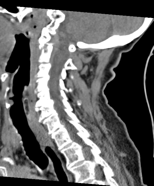 C2 fracture with vertebral artery dissection (Radiopaedia 37378-39199 D 34).png