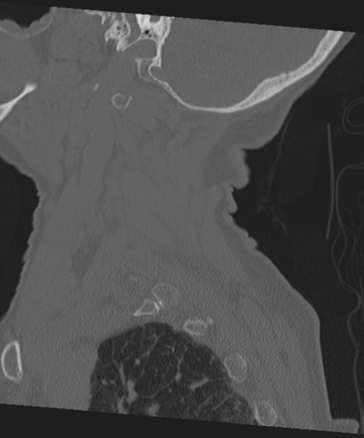 C2 fracture with vertebral artery dissection (Radiopaedia 37378-39199 Sagittal bone window 63).png