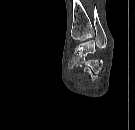 Calcaneal fracture - Sanders type 4 (Radiopaedia 90179-107370 Coronal bone window 61).jpg
