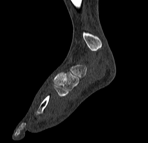 Calcaneal fracture - Sanders type 4 (Radiopaedia 90179-107370 Sagittal bone window 32).jpg
