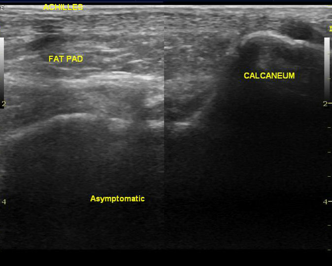 File:Calcaneal tuberosity avulsion fracture (Radiopaedia 42683).jpg