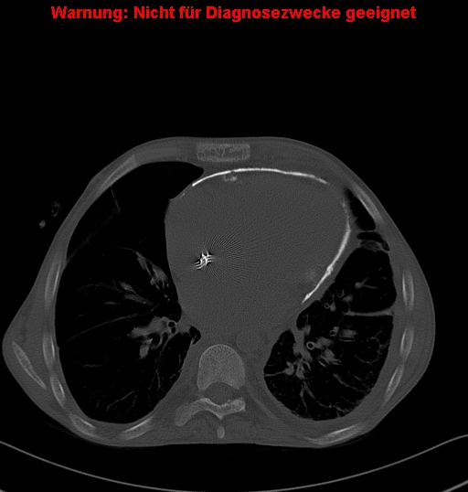 File:Calcific constrictive pericarditis (Radiopaedia 24701-24967 Axial bone window 17).jpg