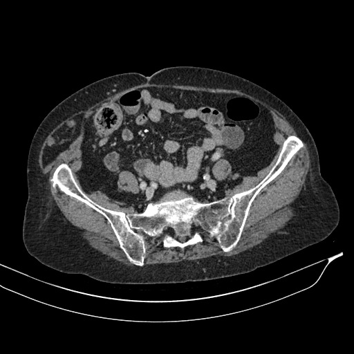 Calcified adrenal glands and Spigelian hernia (Radiopaedia 49741-54988 A 169).jpg