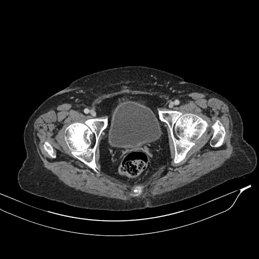 Calcified adrenal glands and Spigelian hernia (Radiopaedia 49741-54988 A 232).jpg