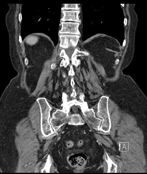 Calcified adrenal glands and Spigelian hernia (Radiopaedia 49741-54988 B 91).jpg