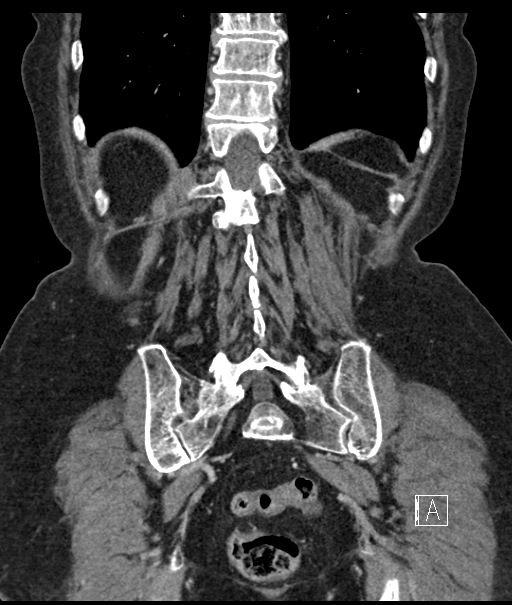 Calcified adrenal glands and Spigelian hernia (Radiopaedia 49741-54988 B 94).jpg