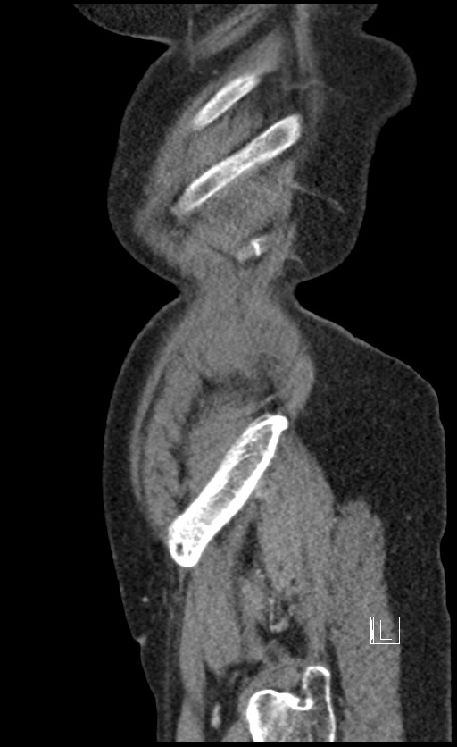 Calcified adrenal glands and Spigelian hernia (Radiopaedia 49741-54988 C 13).jpg