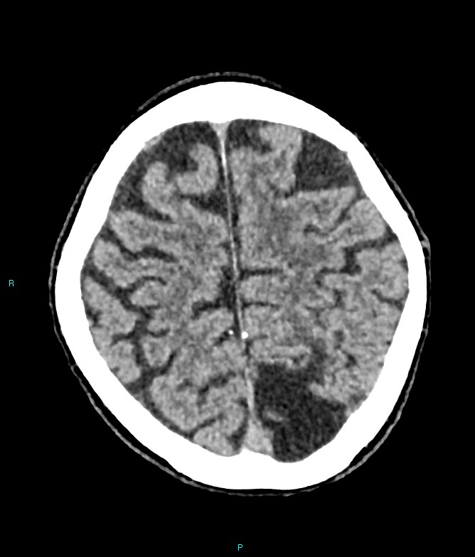 Calcified cerebral emboli from left ventricular thrombus (Radiopaedia 84420-99758 Axial non-contrast 24).jpg