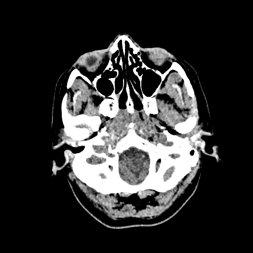 Calcified cerebral hydatid cyst (Radiopaedia 65603-74717 Axial non-contrast 1).jpg