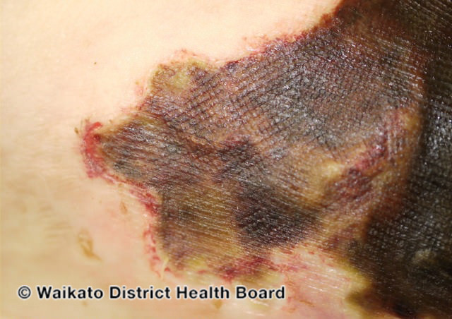 File:Calciphylaxis can lead to- (DermNet NZ systemic-w-calciphylaxis9).jpg