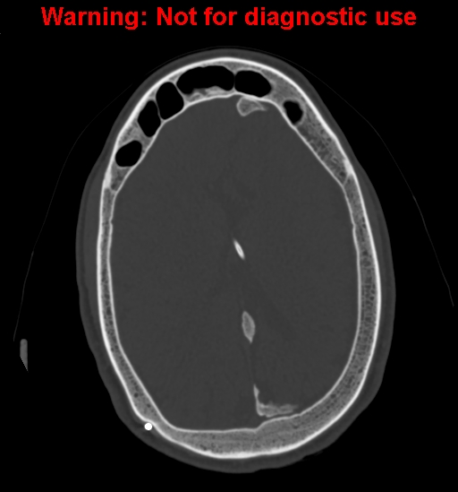 File:Calvarial thickening from chronic shunting (Radiopaedia 60079-67637 Axial bone window 120).jpg