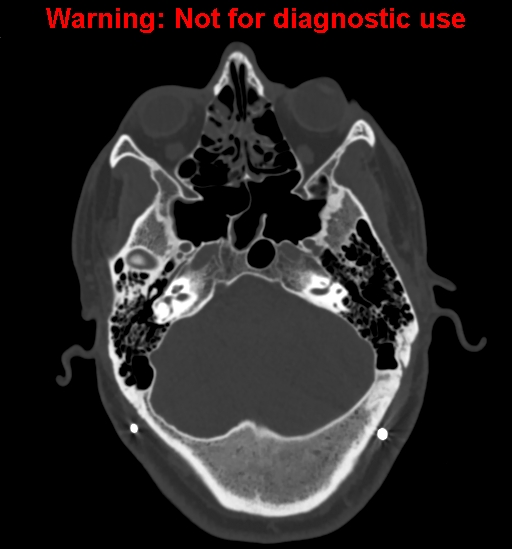 File:Calvarial thickening from chronic shunting (Radiopaedia 60079-67637 Axial bone window 41).jpg