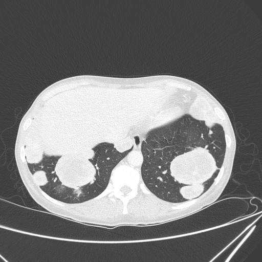Canonball lung metastasis (Radiopaedia 77634-89837 Axial lung window 148).jpg