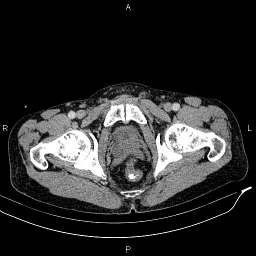 Caput medusae sign - portal hypertension (Radiopaedia 64007-72759 A 100).jpg