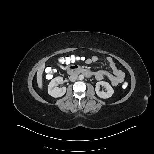 File:Carcinoid tumor - terminal ileum (Radiopaedia 60931-68739 Axial 15).jpg
