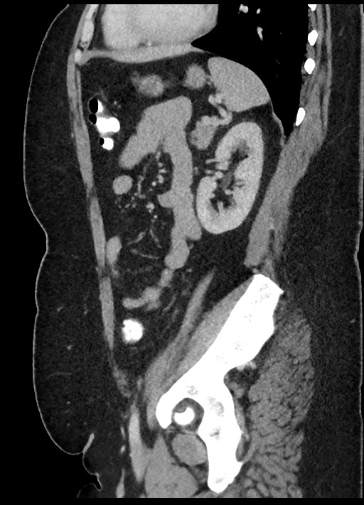 Carcinoid tumor - terminal ileum (Radiopaedia 60931-68739 C 26).jpg