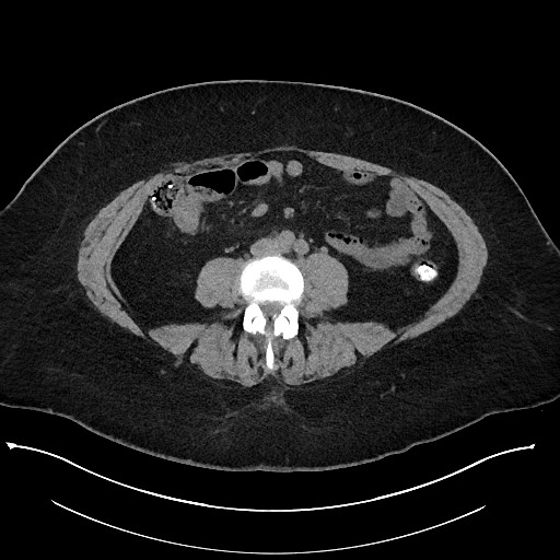 File:Carcinoid tumor - terminal ileum (Radiopaedia 60931-68740 Axial non-contrast 68).jpg