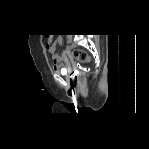 File:Carcinoma cervix- brachytherapy applicator (Radiopaedia 33135-34173 D 79).jpg