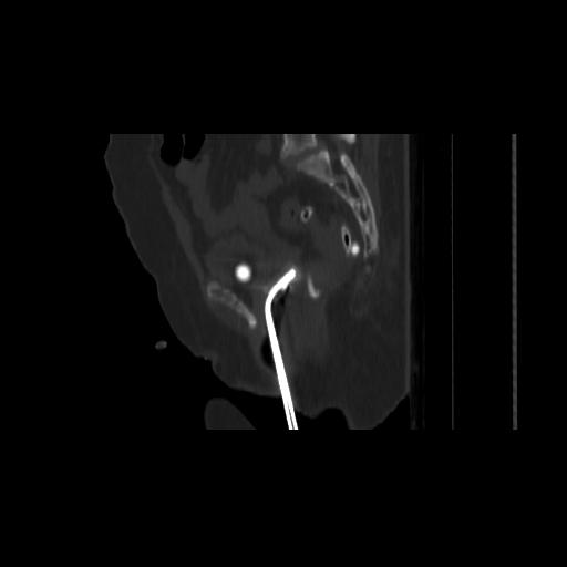 Carcinoma cervix- brachytherapy applicator (Radiopaedia 33135-34173 Sagittal bone window 106).jpg