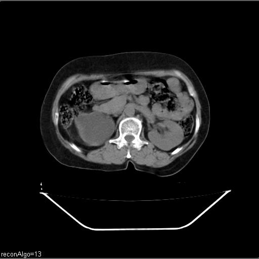 File:Carcinoma cervix- recurrence (Radiopaedia 34702-36137 Axial non-contrast 19).jpg