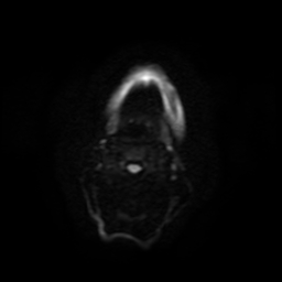 Carcinoma ex-pleomorphic adenoma of parotid (Radiopaedia 28383-28627 Ax DWI B-500 GE 45).jpg