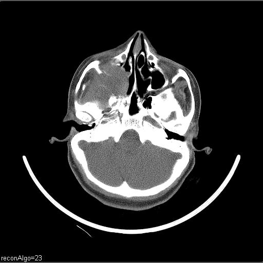 Carcinoma of the maxillary antrum (Radiopaedia 53805-59888 Axial non-contrast 65).jpg