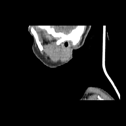 Carcinoma of the maxillary antrum (Radiopaedia 53805-59888 Sagittal C+ delayed 162).jpg