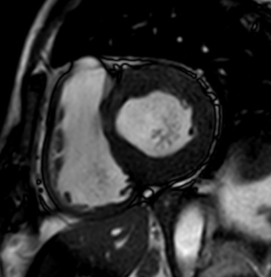 File:Cardiac amyloidosis - ATTR wild-type (Radiopaedia 74412-85296 short axis cine SSFP 125).jpg