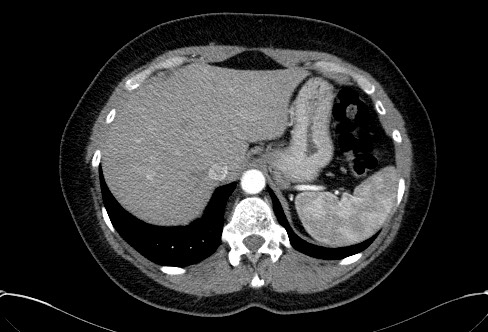 Cardiac sarcoidosis (Radiopaedia 74548-85534 A 83).jpg