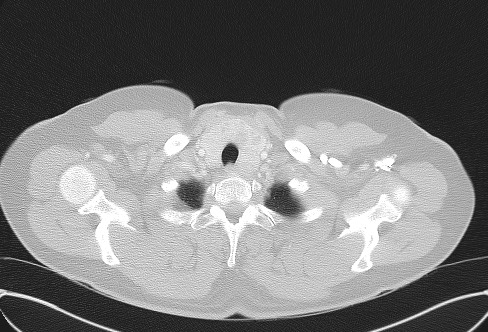File:Cardiac sarcoidosis (Radiopaedia 74548-85534 Axial lung window 5).jpg