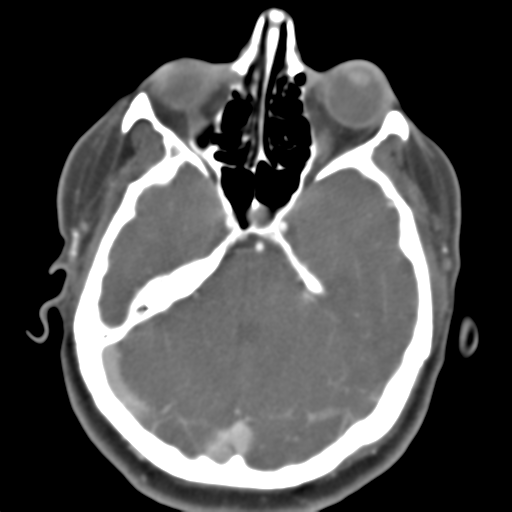 Carotico ophthalmic aneurysm (Radiopaedia 42916-46148 A 38).png