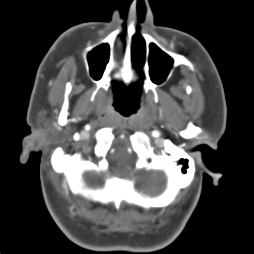 Carotico ophthalmic aneurysm (Radiopaedia 42916-46148 A 48).png