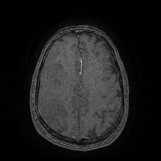 Carotid arterial dissection with acute cerebral infarction (Radiopaedia 26636-26784 MRA 30).jpg