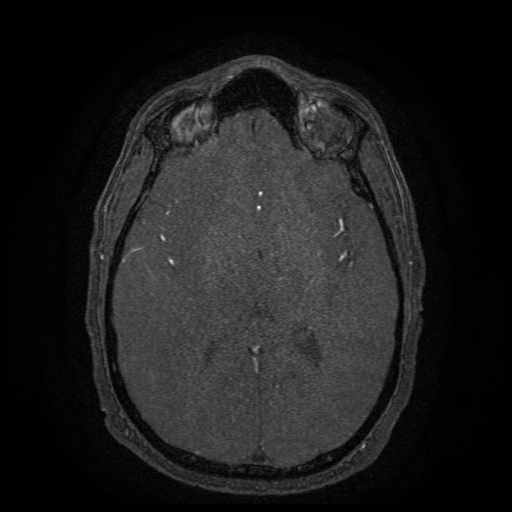 Carotid arterial dissection with acute cerebral infarction (Radiopaedia 26636-26784 MRA 74).jpg