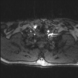 File:Carotid artery dissection (Radiopaedia 28441-28689 Axial MRA 9).jpg